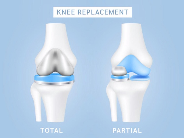 Diferencia entre reemplazo total y parcial de rodilla: una guía completa
